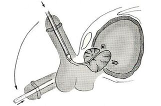 Схема на ендоскопска операция за уголемяване на пениса