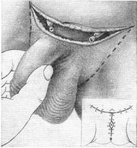 Хирургично удължаване на пениса чрез издърпване на скритата му част